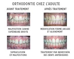 Appareil dentaire adulte