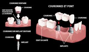 Couronne dentaire : durée