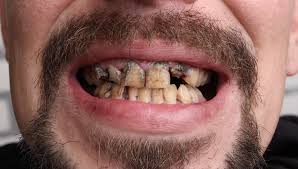 Dent noire : causes