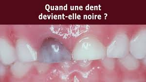 Dent qui noircit : causes, traitements et solutions pour retrouver un sourire sain