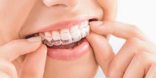esthétique dentaire, dentisterie esthétique, blanchiment dentaire, facettes dentaires, sourire parfait, orthodontie invisible Invisalign, Centre Dentaire Al Akhawayn, dentiste Casablanca, sourire harmonieux, restauration esthétique dentaire