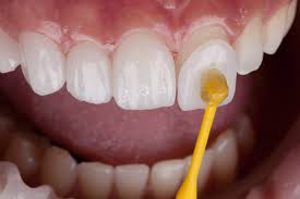 Facette composite