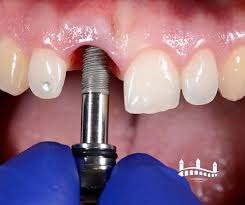 Implant douleur