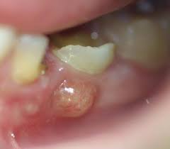 Infection dent remède