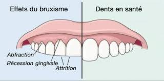 Bruxisme : causes et traitement