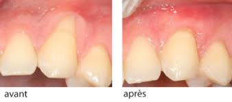 Déchaussement des dents : solutions
