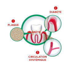 Santé dentaire et diabète