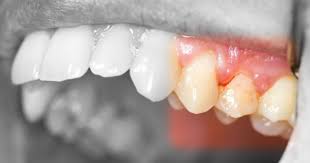 Gencive gonflée : que faire ?