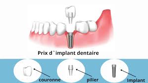 Combien coûte un implant dentaire ?