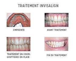 Invisalign : fonctionnement et prix