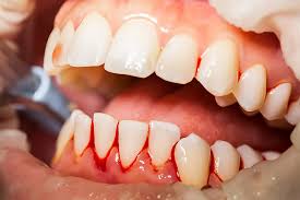 Saignement des gencives : causes