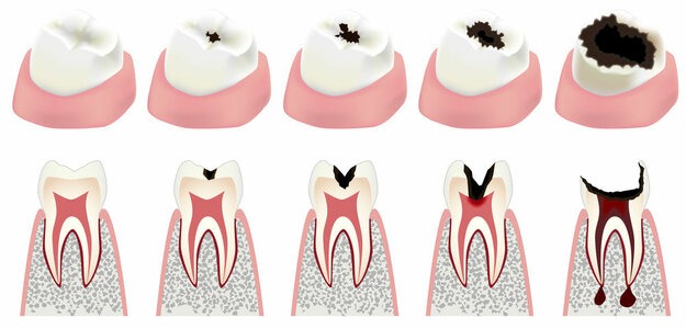 Soins des caries