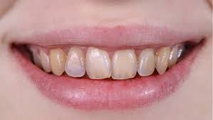 Calcium dents