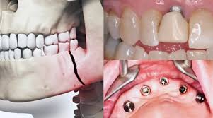 Complications dentaires
