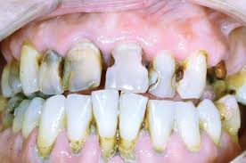 Dent-et-diabete