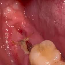 Infection après extraction
