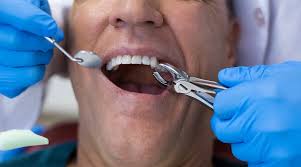 Prix extraction dent