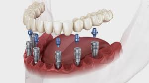 Prix implant Maroc