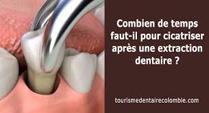 Temps guérison dent