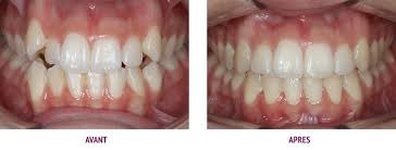 Avant après orthodontie