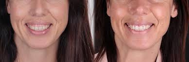 Correction sourire