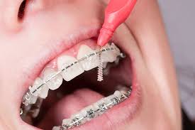 Hygiène orthodontie
