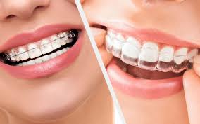 Orthodontie chez l’adulte