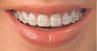 Orthodontie invisible prix