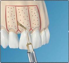 Orthodontie rapide