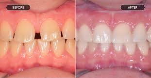 Plan traitement dents