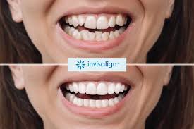 Résultat Invisalign