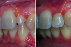 Résultat orthodontie