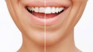 Soins esthétiques dents