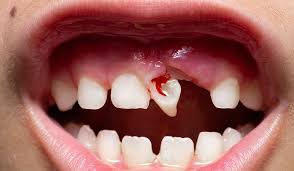 Urgence enfant dent
