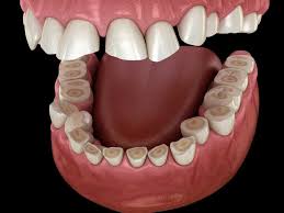 Usure dents